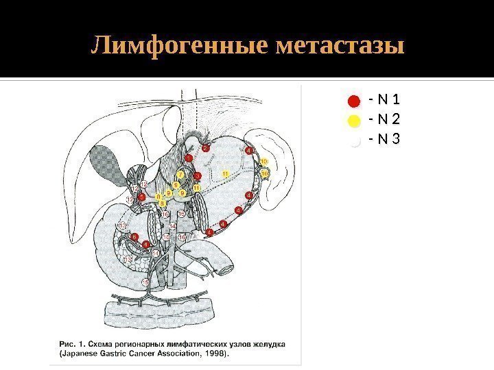 Лимфогенные метастазы - N 1 - N 2 - N 3 01 01 01