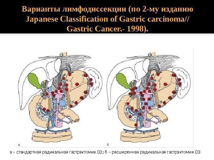 Варианты лимфодиссекции (по 2 -му изданию Japanese Classification of Gastric carcinoma// Gastric Cancer. -