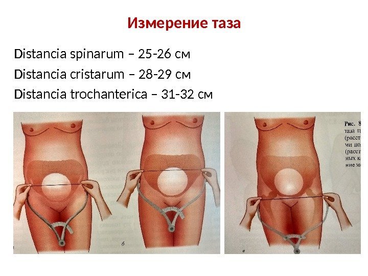 Измерение таза Distancia spinarum – 25 -26 см Distancia cristarum – 28 -29 см