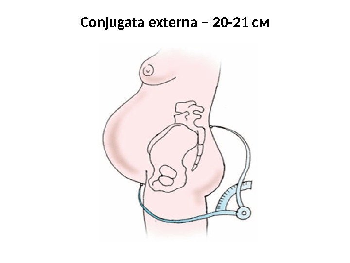 Conjugata externa – 20 -21 см 