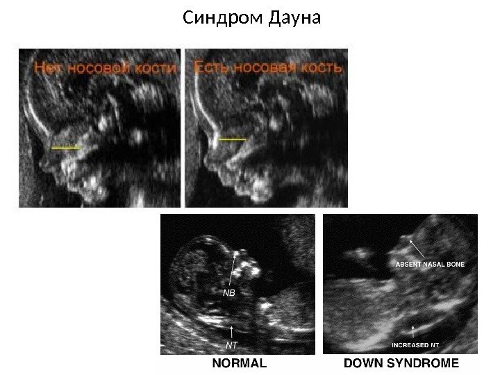 Синдром Дауна 