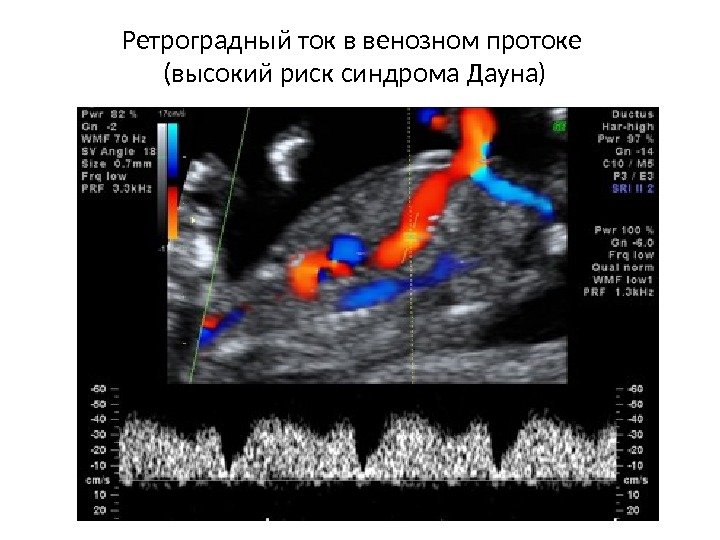 Ретроградный ток в венозном протоке (высокий риск синдрома Дауна) 