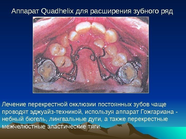 Аппарат Quadhelix для расширения зубного ряд Лечение перекрестной окклюзии постоянных зубов чаще проводят эджуайз-техникой,