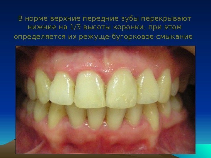 В норме верхние передние зубы перекрывают нижние на 1/3 высоты коронки, при этом определяется