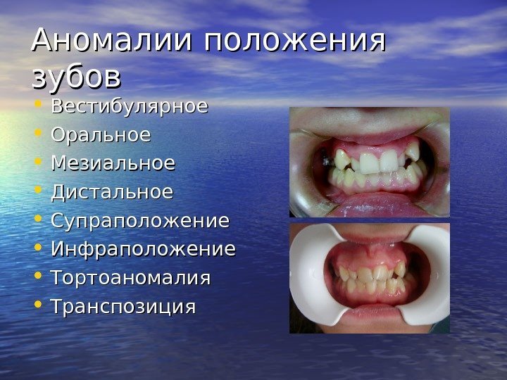   Аномалии положения зубов • Вестибулярное • Оральное • Мезиальное • Дистальное •