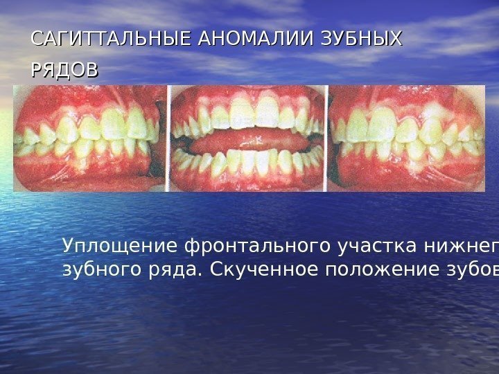   САГИТТАЛЬНЫЕ АНОМАЛИИ ЗУБНЫХ РЯДОВ  Уплощение фронтального участка нижнего зубного ряда. Скученное
