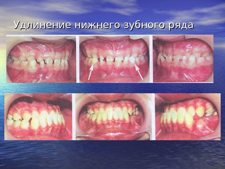   Удлинение нижнего зубного ряда 
