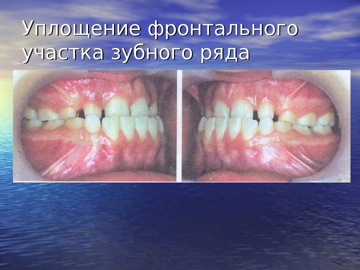   Уплощение фронтального участка зубного ряда 
