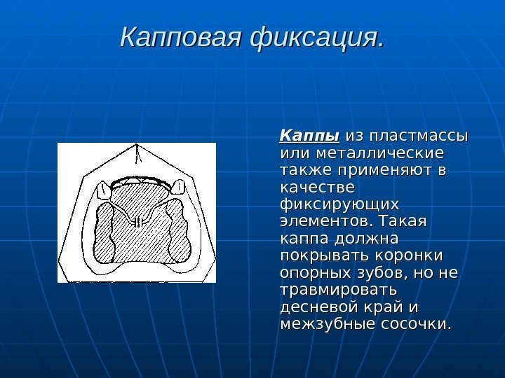   Капповая фиксация. Каппы из пластмассы или металлические также применяют в качестве фиксирующих