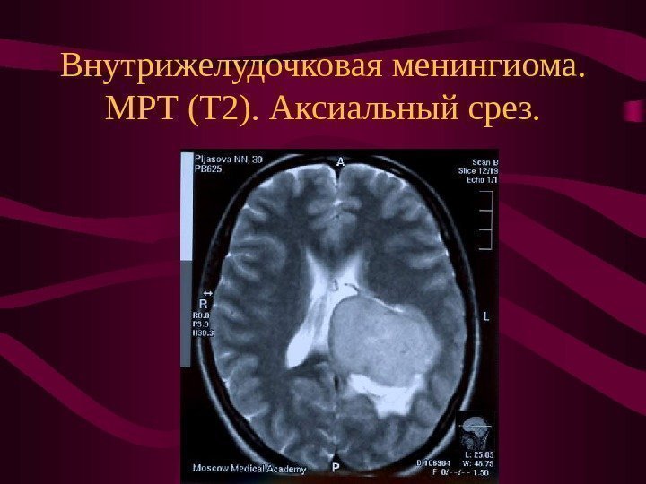   Внутрижелудочковая менингиома.  МРТ (Т 2). Аксиальный срез. 