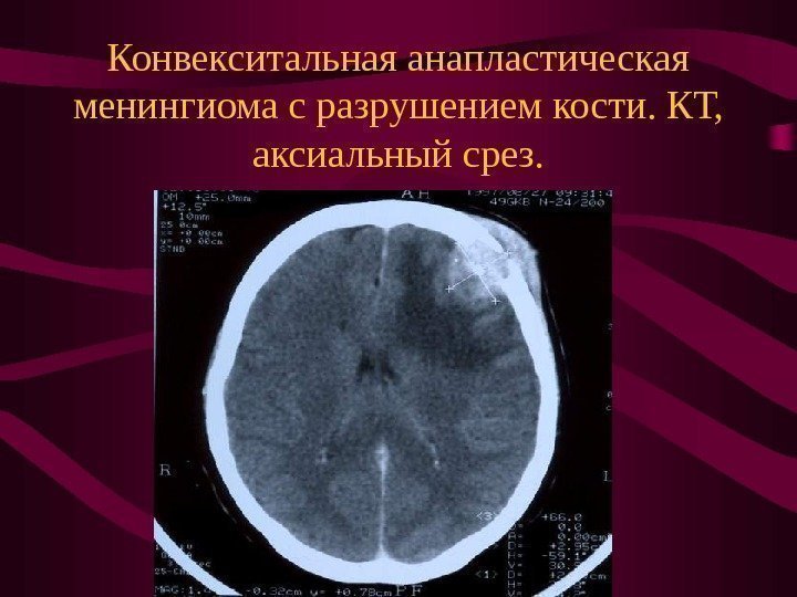   Конвекситальная анапластическая менингиома с разрушением кости. КТ,  аксиальный срез. 