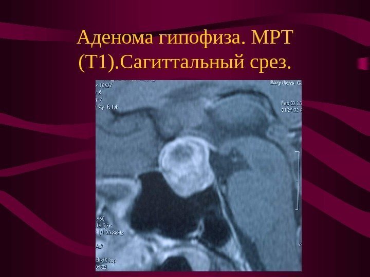   Аденома гипофиза. МРТ (Т 1). Сагиттальный срез. 