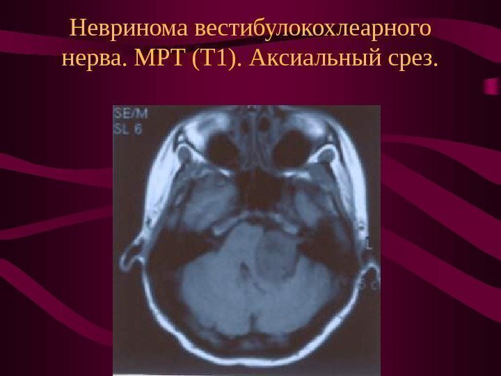   Невринома вестибулокохлеарного нерва. МРТ (Т 1). Аксиальный срез. 