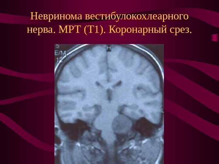   Невринома вестибулокохлеарного нерва. МРТ (Т 1). Коронарный срез. 