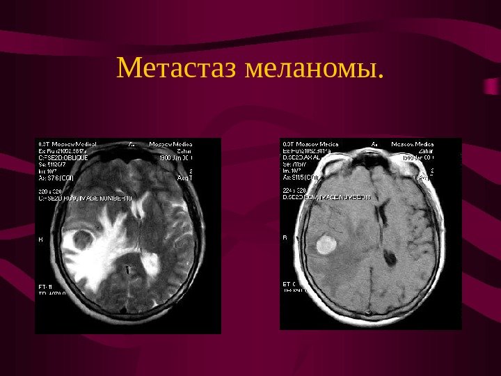   Метастаз меланомы. 