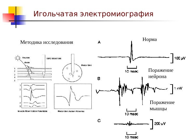 Игольчатая электромиография Методика исследования Норма Поражение нейрона Поражение мышцы 