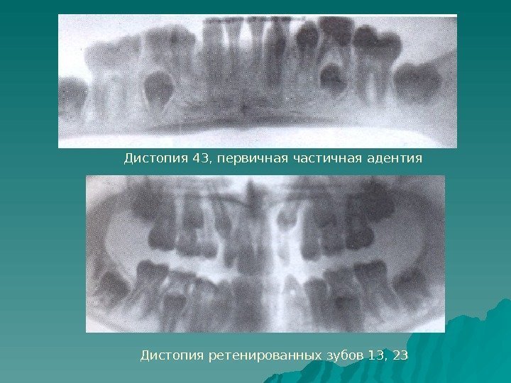   Дистопия 43, первичная частичная адентия Дистопия ретенированных зубов 13, 23 