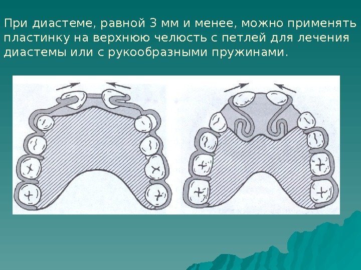   При диастеме, равной 3 мм и менее, можно применять пластинку на верхнюю