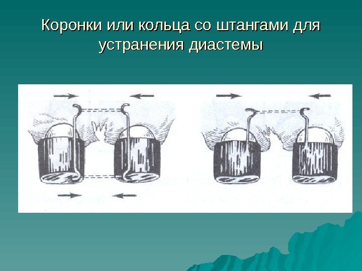   Коронки или кольца со штангами для устранения диастемы 