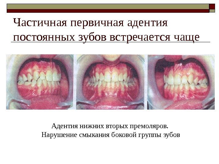 Частичная первичная адентия постоянных зубов встречается чаще Адентия нижних вторых премоляров.  Нарушение смыкания