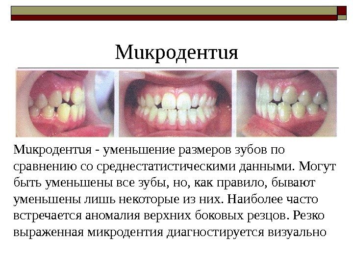 Мuкродентuя - уменьшение размеров зубов по сравнению со среднестатистическими данными. Могут быть уменьшены все