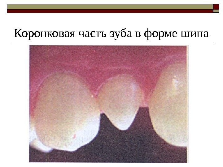 Коронковая часть зуба в форме шипа 
