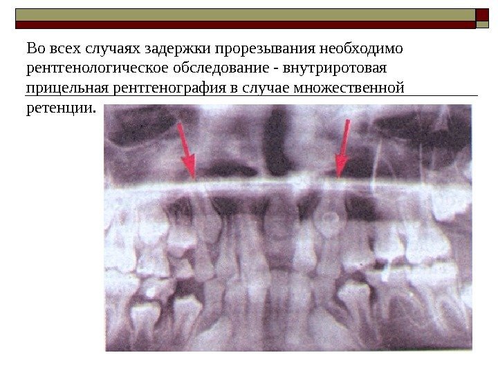 Во всех случаях задержки прорезывания необходимо рентгенологическое обследование - внутриротовая прицельная рентгенография в случае