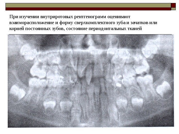 При изучении внутриротовых рентгенограмм оценивают взаиморасположение и форму сверхкомплектного зуба и зачатков или корней