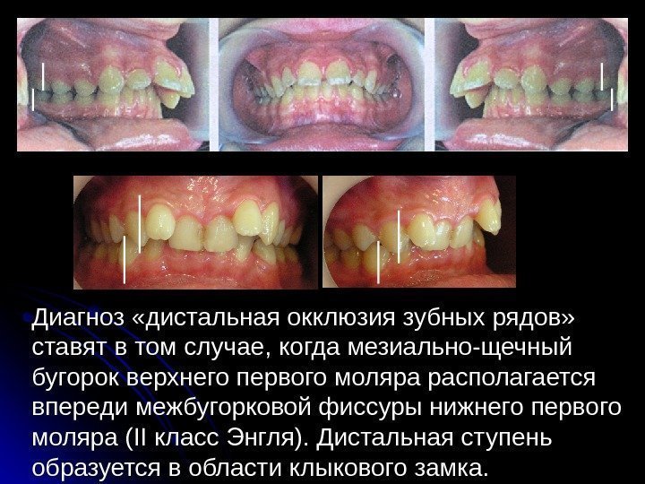 Диагноз «дистальная окклюзия зубных рядов»  ставят в том случае, когда мезиально-щечный бугорок верхнего