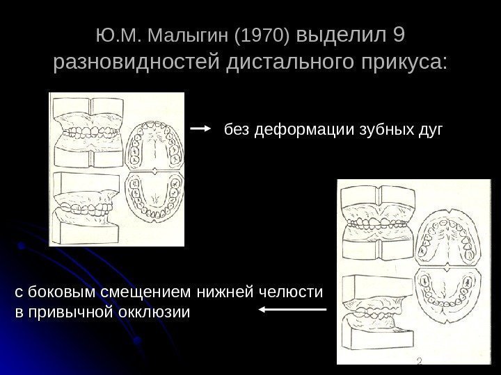 Ю. М. Малыгин (1970) выделил 9 разновидностей дистального прикуса: без деформации зубных дуг с