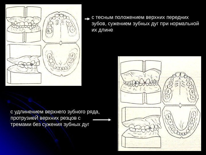 с тесным положением верхних передних зубов, сужением зубных дуг при нормальной их длине с