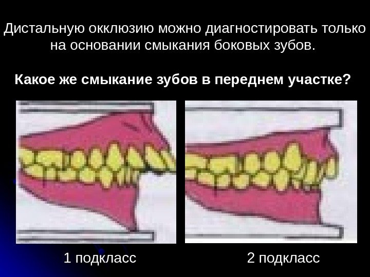 Дистальную окклюзию можно диагностировать только на основании смыкания боковых зубов.  Какое же смыкание