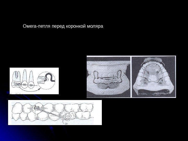 Омега-петля перед коронкой моляра 