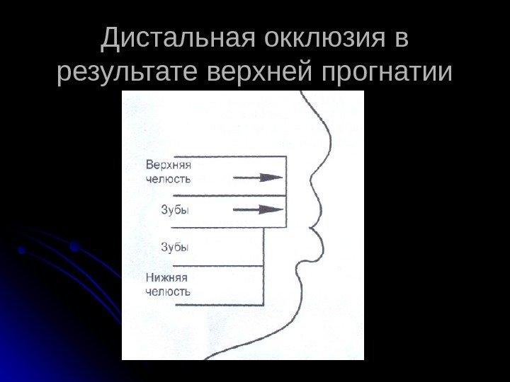 Дистальная окклюзия в результате верхней прогнатии 