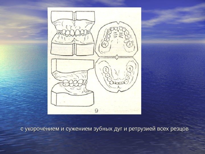   с укорочением и сужением зубных дуг и ретрузией всех резцов 