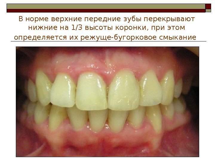   В норме верхние передние зубы перекрывают нижние на 1/3 высоты коронки, при