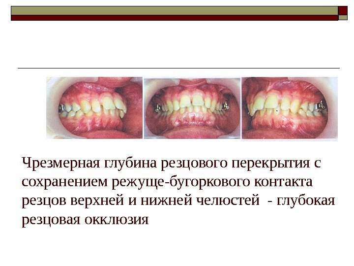   Чрезмерная глубина резцового перекрытия с сохранением режуще-бугоркового контакта резцов верхней и нижней