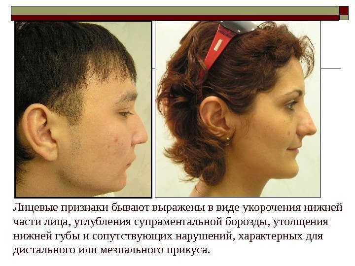   Лицевые признаки бывают выражены в виде укорочения нижней части лица, углубления супраментальной
