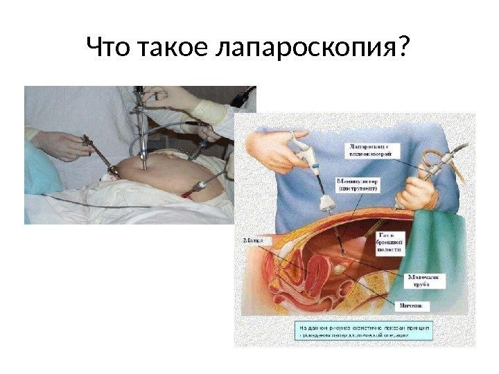 Что такое  лапароскопия? 