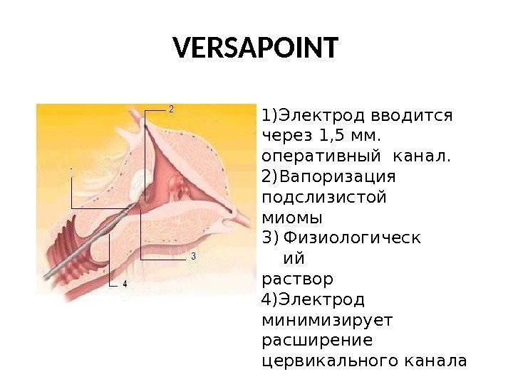 VERSAPOINT 1) Электрод вводится  через 1, 5 мм.  оперативный канал. 2) Вапоризация