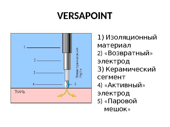 VERSAPOINT 1) Изоляционный материал 2) « Возвратный » электрод 3) Керамический сегмент 4) «