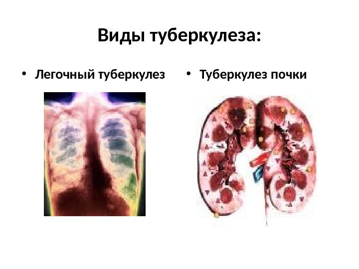 Виды туберкулеза:  • Легочный туберкулез  • Туберкулез почки 