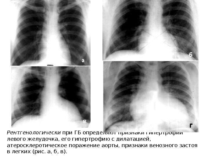 Рентгенологически при ГБ определяют признаки гипертрофии левого желудочка, его гипертрофию с дилатацией,  атеросклеротическое