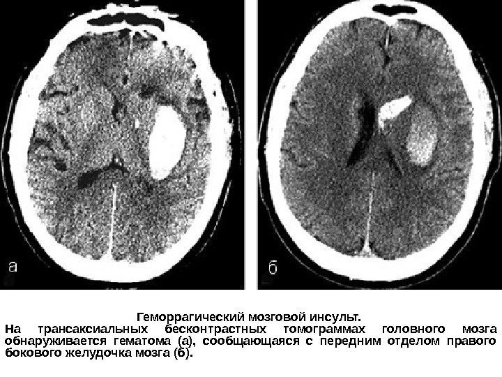 Геморрагический мозговой инсульт.  На трансаксиальных бесконтрастных томограммах головного мозга обнаруживается гематома (а), 