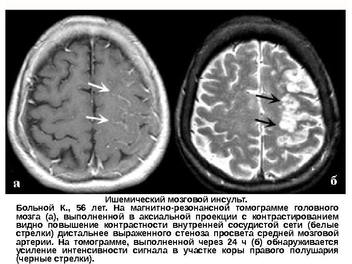 Ишемический мозговой инсульт.  Больной К. ,  56 лет.  На магнитно-резонансной томограмме