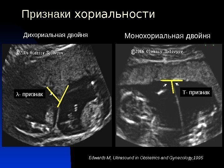 Признаки хор и альност и  Дихориальная двойня Edwards M, Ultrasound in Obstetrics and