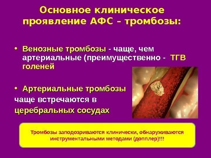 Основное клиническое проявление АФС – тромбозы:  • Венозные тромбозы - чаще, чем артериальные