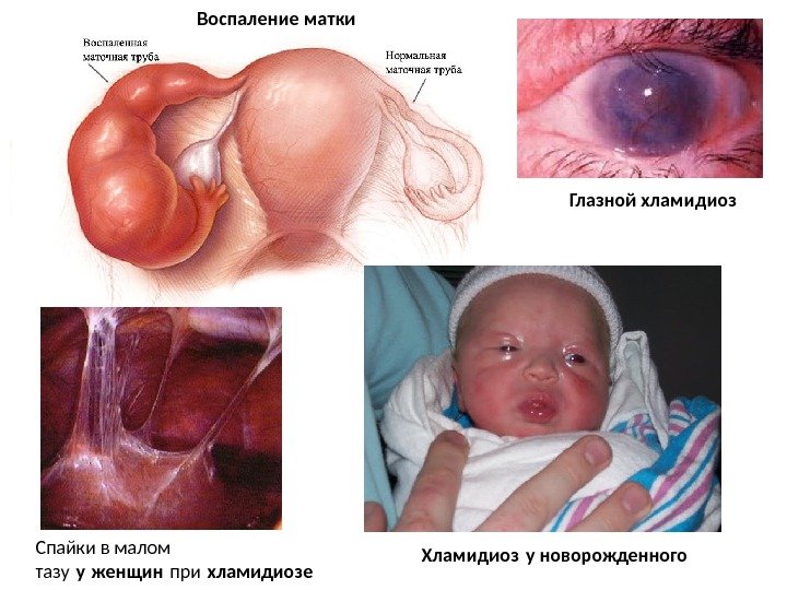 Воспаление матки Спайки в малом тазу у женщин при хламидиозе Хламидиоз у новорожденного Глазной