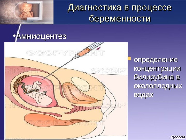  определение концентрации билирубина в околоплодных водах. Диагностика в процессе беременности • Амниоцентез 