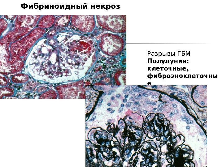 Фибриноидный некроз Разрывы ГБМ Полулуния : :  клеточные , ,  фиброзноклеточны ее